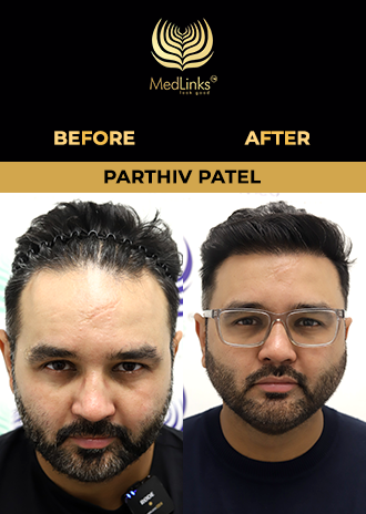 Parthiv Patel hair transplant before and after
